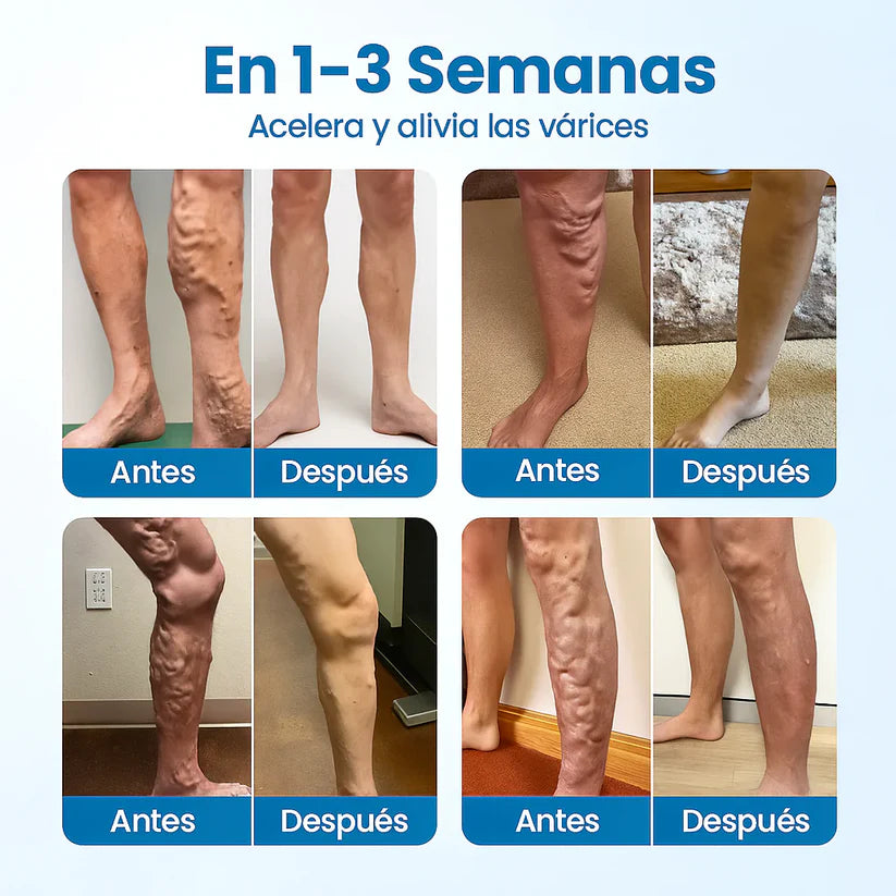 🔥 Lleva 2 + 1 GRATIS – VarixFree® Spray Herbal Plus 🌿